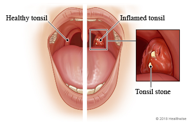 Tonsil Stones Home Remedies