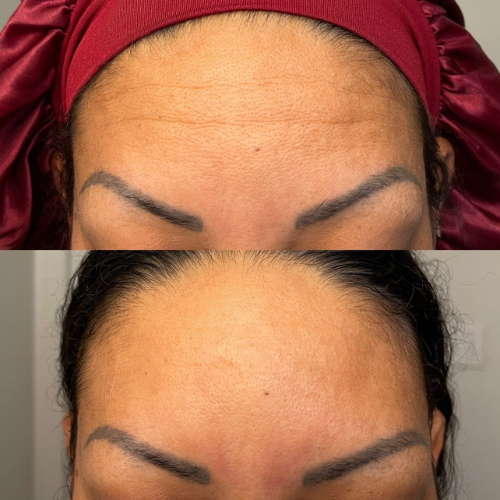 Forehead Wrinkle Solutions